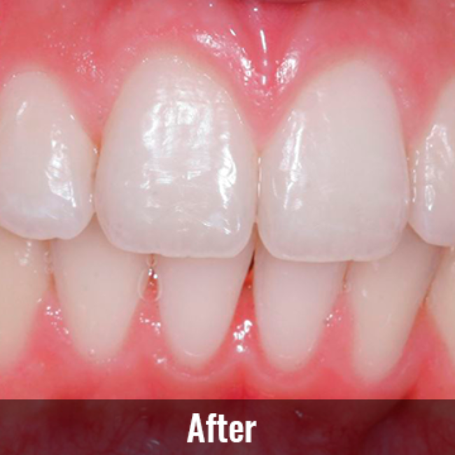 Mountain View Dentist veneers crowns implants orthodontics braces Invisalign