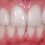 Mountain View Dentist veneers crowns implants orthodontics braces Invisalign