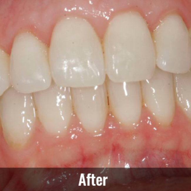 Mountain View Dentist veneers crowns implants orthodontics braces Invisalign