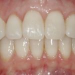 Mountain View Dentist veneers crowns implants orthodontics braces Invisalign