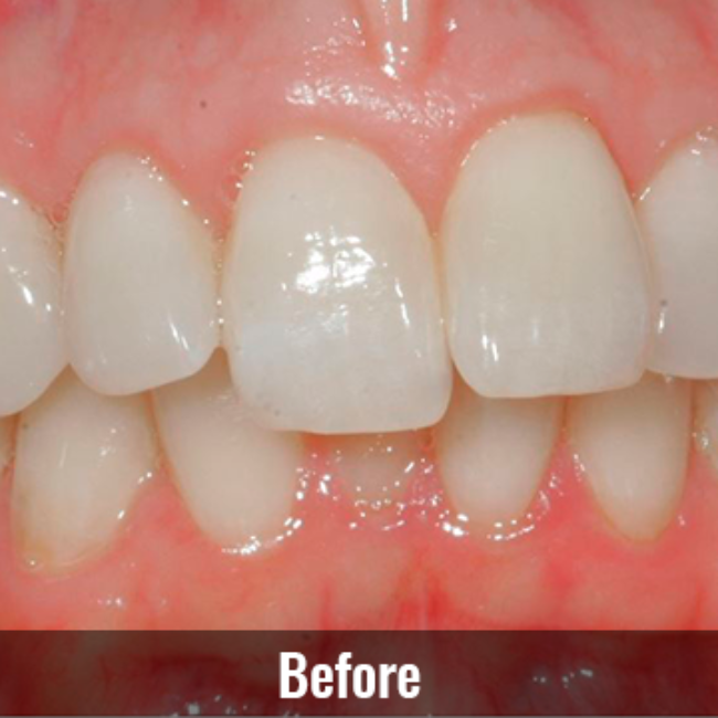 Mountain View Dentist veneers crowns implants orthodontics braces Invisalign