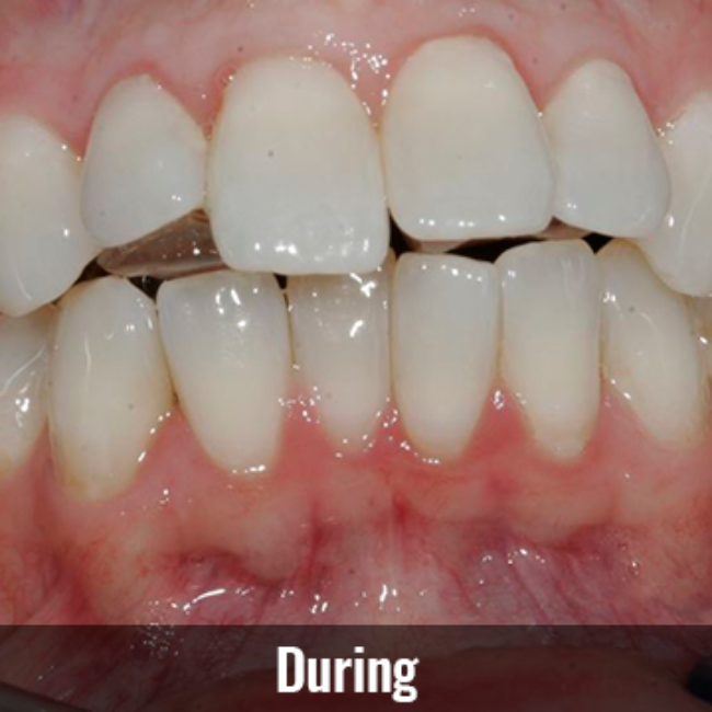 Mountain View Dentist veneers crowns implants orthodontics braces Invisalign