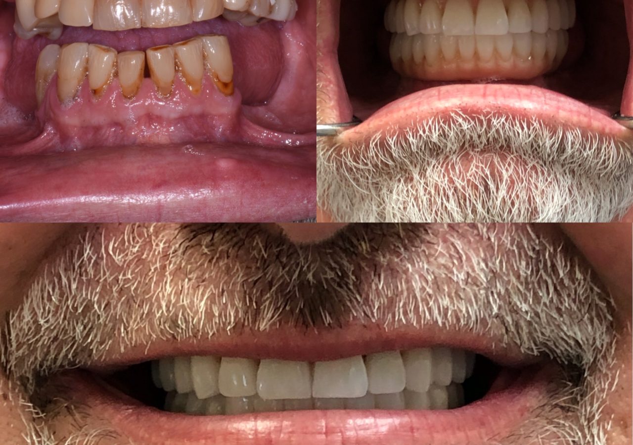 Mountain View Dentist veneers crowns implants orthodontics braces Invisalign