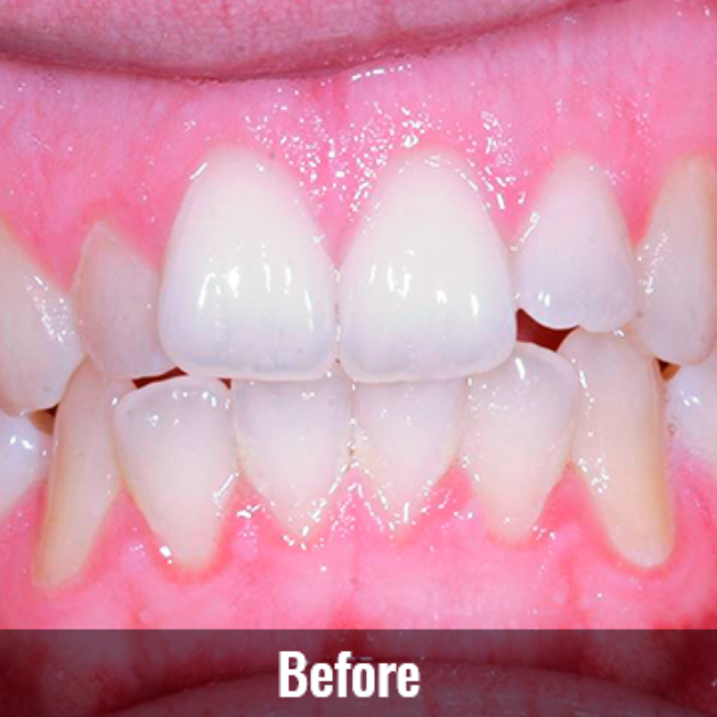 Mountain View Dentist veneers crowns implants orthodontics braces Invisalign