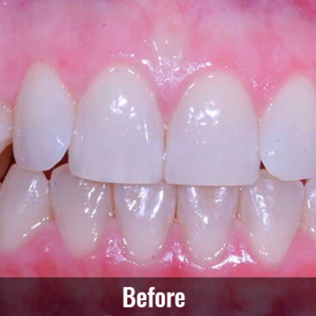 Mountain View Dentist veneers crowns implants orthodontics braces Invisalign