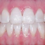 Mountain View Dentist veneers crowns implants orthodontics braces Invisalign