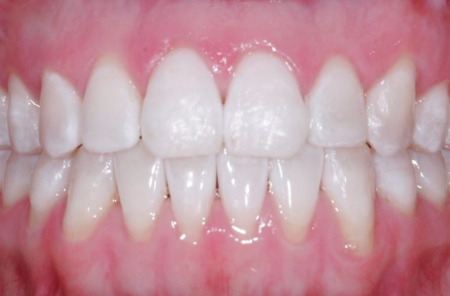 Invisalign