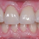 Mountain View Dentist veneers crowns implants orthodontics braces Invisalign