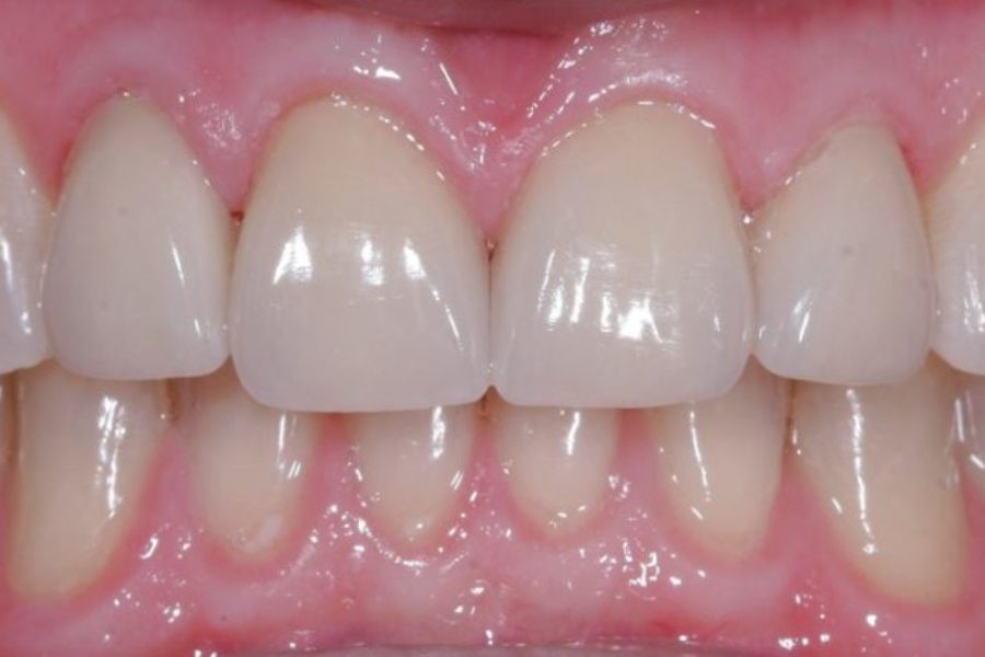 Veneers