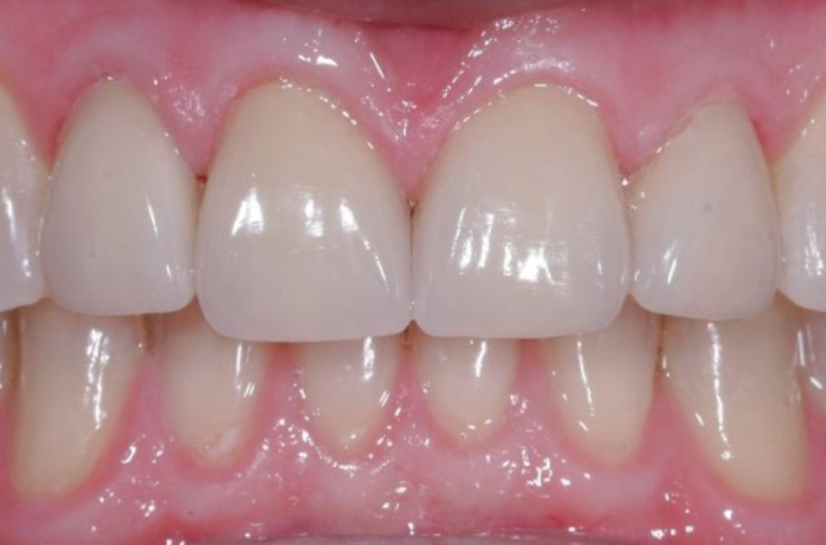 Veneers