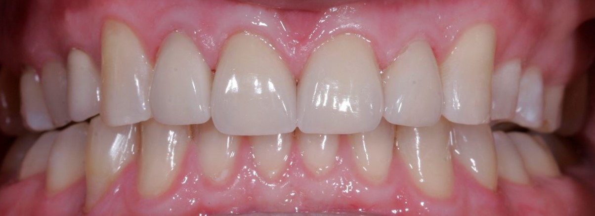 Veneers