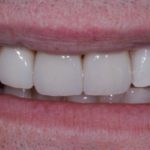 Mountain View Dentist veneers crowns implants orthodontics braces Invisalign