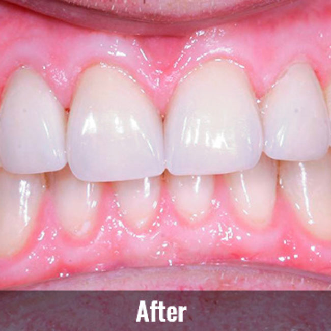Mountain View Dentist veneers crowns implants orthodontics braces Invisalign