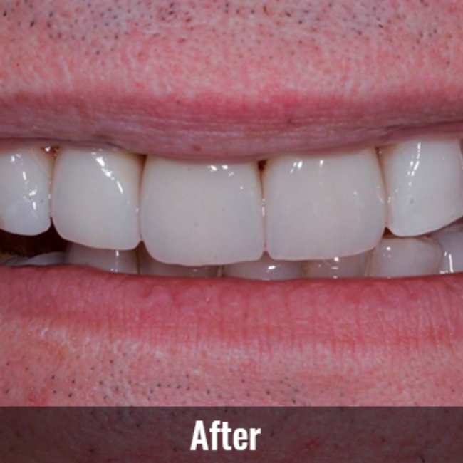 Mountain View Dentist veneers crowns implants orthodontics braces Invisalign