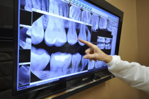digital-xray Mountain View Dentist veneers crowns implants orthodontics braces Invisalign