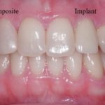 Mountain View Dentist veneers crowns implants orthodontics braces Invisalign