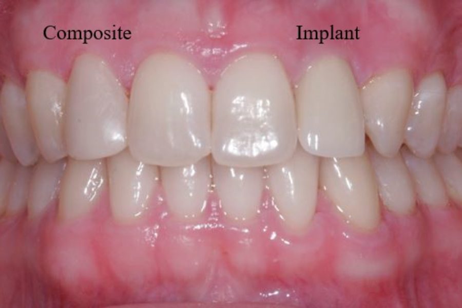 Implant/Composite