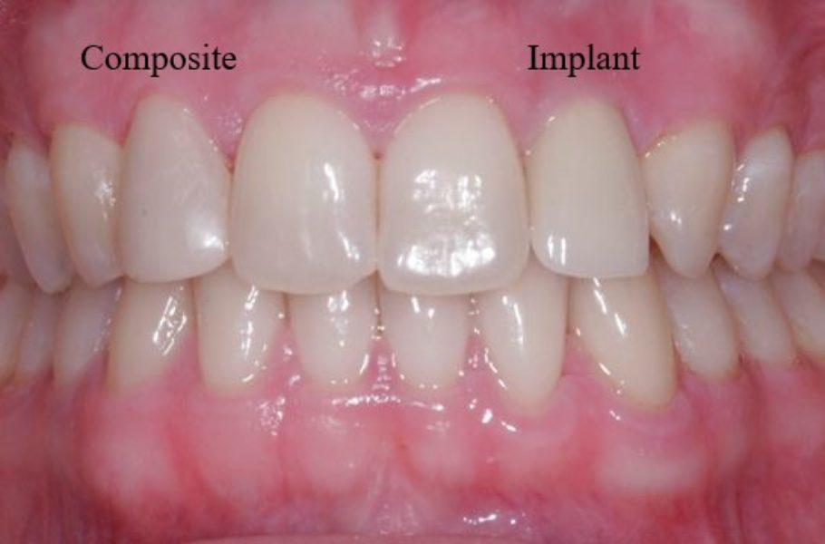 Implant/Composite