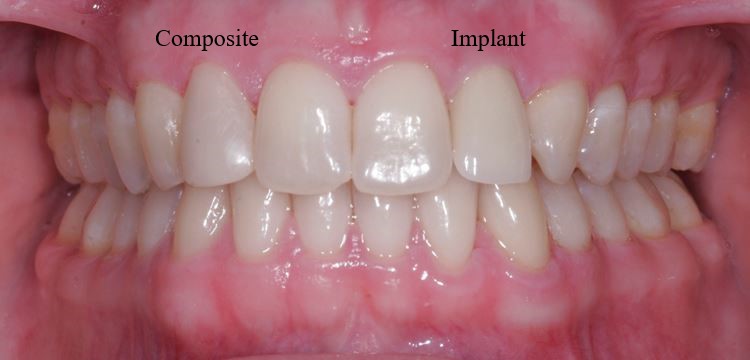 Implant/Composite