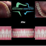 Mountain View Dentist veneers crowns implants orthodontics braces Invisalign