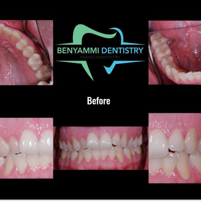 Mountain View Dentist veneers crowns implants orthodontics braces Invisalign