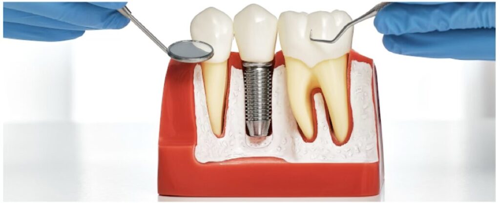 Benyammi Family Dentistry, Mountain View CA dental implant