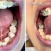 Tongue Ties