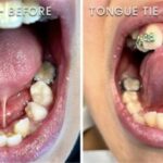 Tongue Ties, Mt. View Dentist