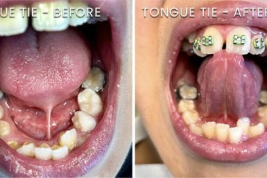 Tongue Ties