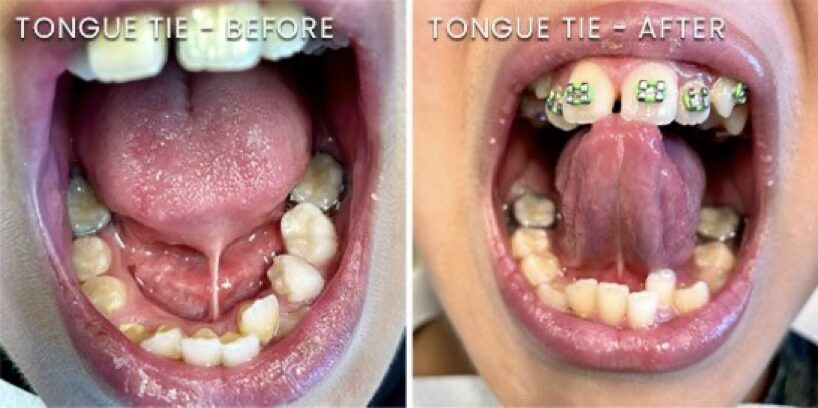 Tongue Ties, Mt. View Dentist
