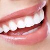 Veneers