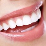 veneers mt. view dentist