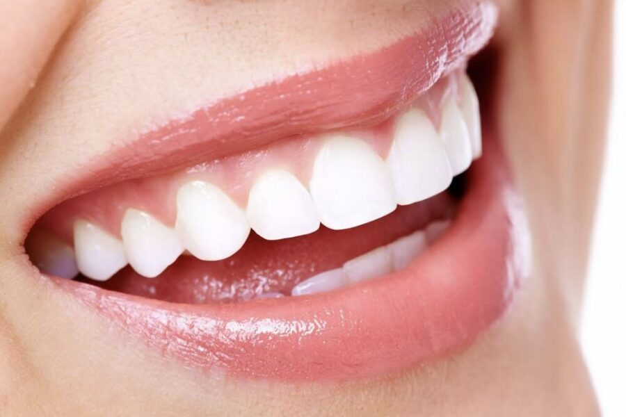Veneers